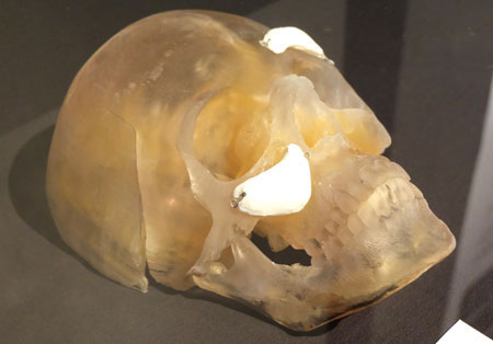 Ungeahnte Perspektiven, allein in der plastischen Chirurgie zeigt dieses Schädel-Exponat: 3D geplante und gedruckte Implantate zum Knochenaufbau einer vererbten Knochenfehlbildung des Gesichtsausdrucks. © massow-picture 
