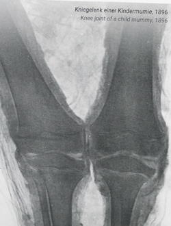 Kniegelenk einer Kindermumie.  Die erste Röntgenaufnahme einer ägyptischen Mumie überhaupt, nach der sensationellen Entdeckung der nach W.C. Röntgen benannten Strahlen. Foto aus Tafel Station 4: Diether v. Goddenthow